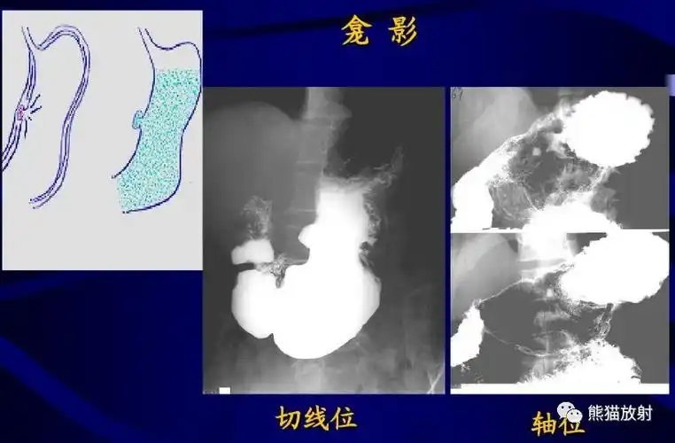 x线诊断要点丨慢性胃炎胃溃疡