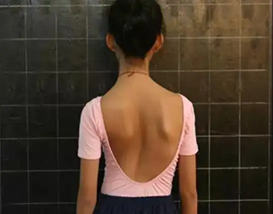 神经内科脊柱侧弯专题学习沙龙顺利举行