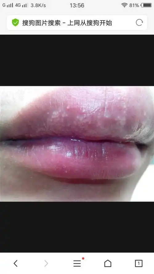 上嘴唇有好多白色小点点 好多年了都 越来越多 跟图片中的差不多 怎么