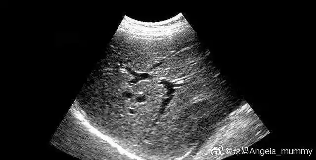 疾病指标解读消化系统篇脂肪肝