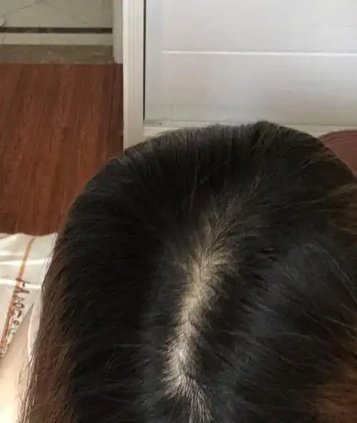姐妹们,这个发缝是脱发吗?