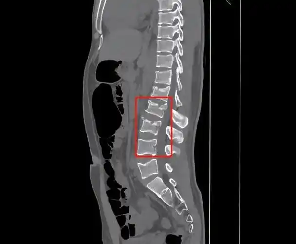 ct检查后显示腰椎椎体1-3骨折.