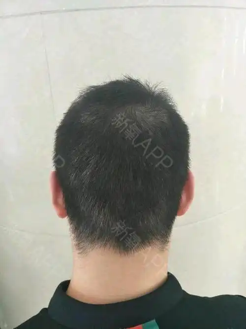 植发也快半你年了,继续给大家分享我的植发经历