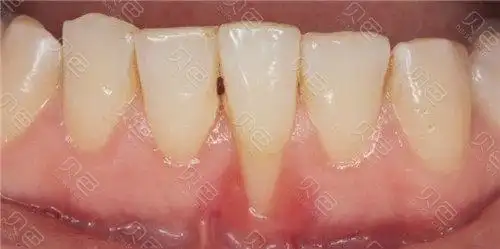牙槽骨吸收后的牙齿照片