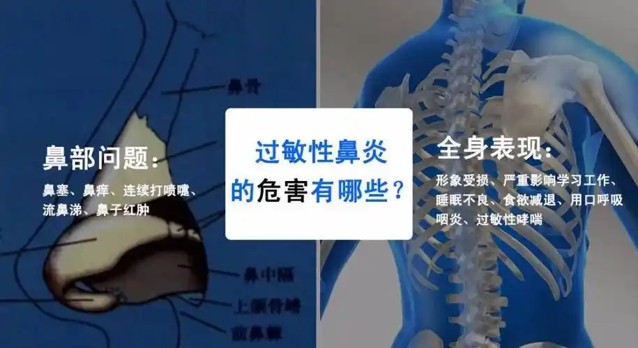 性炎症,即机体对某些过敏原敏感性增高而发生在鼻腔粘膜的变态反应,是