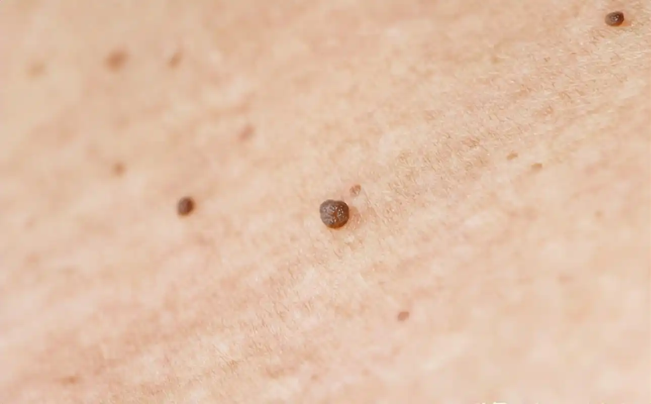 疣图片初期图片(脖子和腋下的) - 赤虎壹号