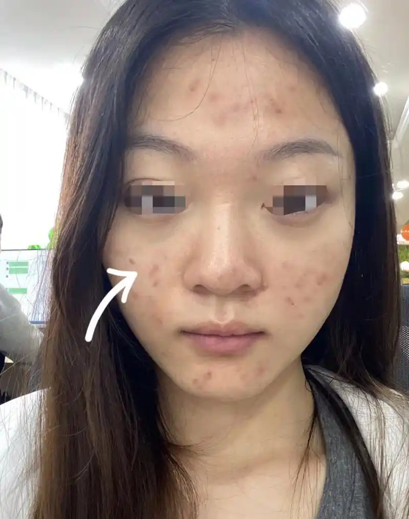 我原来的痘印脸我真的是受不了了,长了一脸,我是大油皮超级容易爆痘.