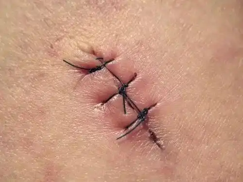 顺产时,自然撕裂与侧切有什么不同?产科医生站出来为大家说真话