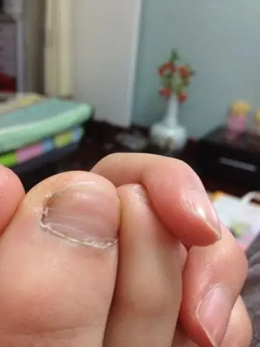 为什么就两个大脚趾有点凹凸不平,就是有一道是特别突出的东西