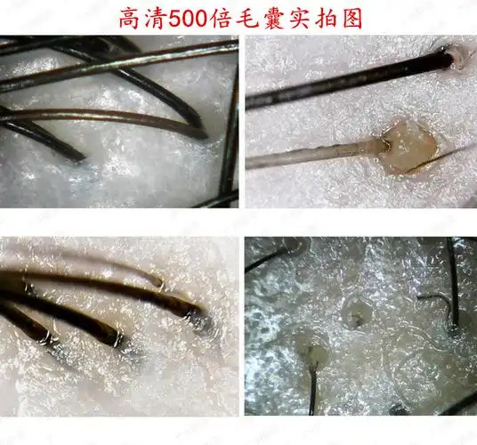 头皮毛囊头发检测仪皮肤测试仪器毛孔放大镜理发店usb接手机高清白色