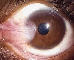 org360 馆藏分类 (pterygium) 翼状胬肉是临床上最为常见的眼科疾病之
