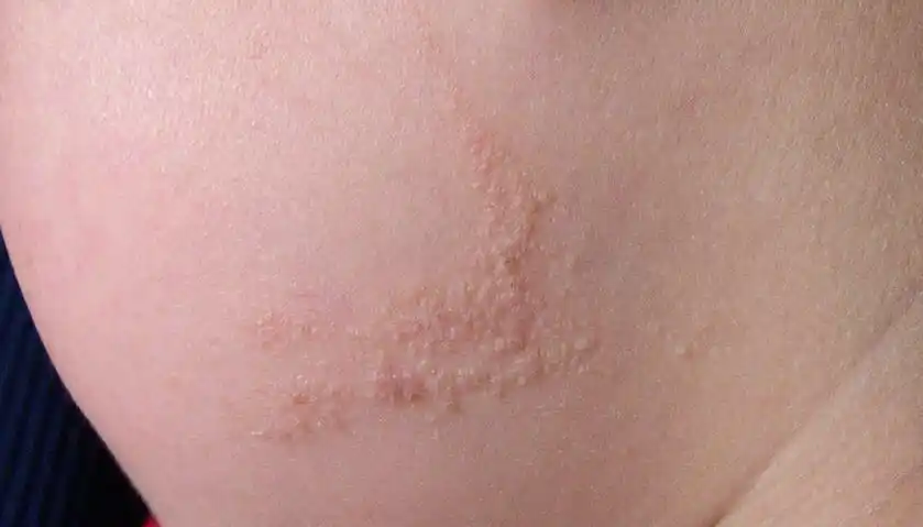 大部分线状表皮痣在出生后或者1岁以内出现,个别在儿童和成人期出现.