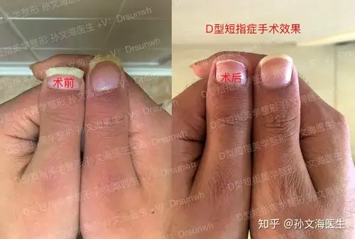 d型短指的神奇手术效果