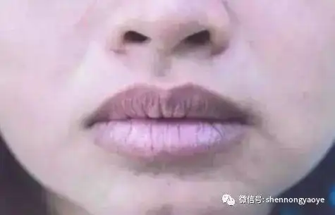嘴唇发暗发紫是怎么回事
