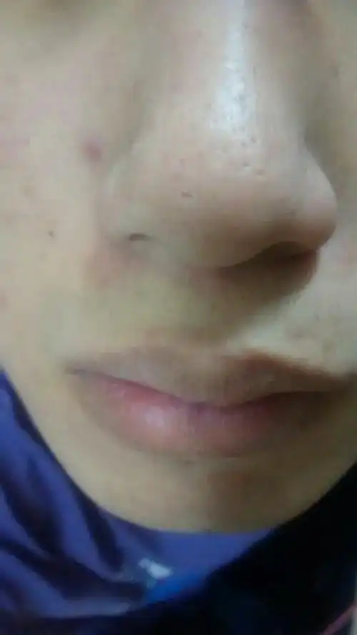 鼻子上有这些坑怎么修啊?感觉用了那种导出液的膜后更明显了.
