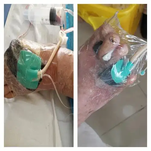 促进压疮创面修复的前提是彻底外科清创和创面抗感染治疗,prp含有