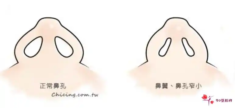 朝天鼻怎么办 朝天鼻怎么回事