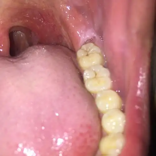 上火了,刚才照镜子不小心看到左边最后一颗牙旁边的肉好像被虫子吃了?