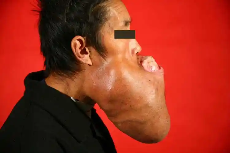 巨大下颌骨肿瘤术前右侧位相