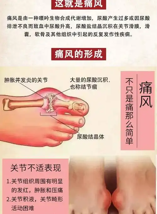 痛风贴 怪大夫 尿酸 手脚踝 膝盖止痛关节疼痛肿胀茶变形酸胀排酸麻痹