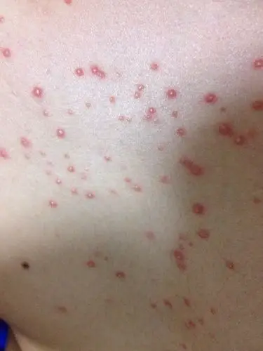 胸口起了很多这种红色小脓包 而且有点扩散 请问这是什么皮肤病