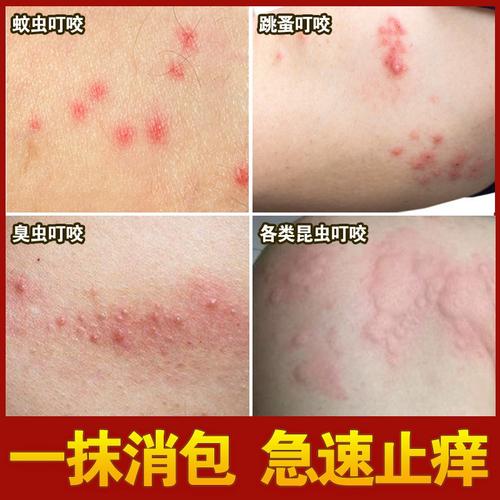 速发跳蚤蚊虫叮咬止痒药膏婴儿隐翅虫蚊子螨虫臭虫咬伤药过敏外用