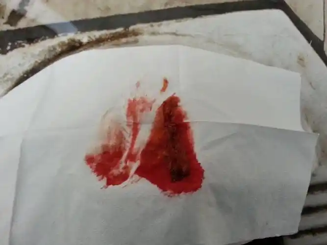 我在上完卫生间的时候,突然发现我用用过的纸巾上留有血,医生我该怎么