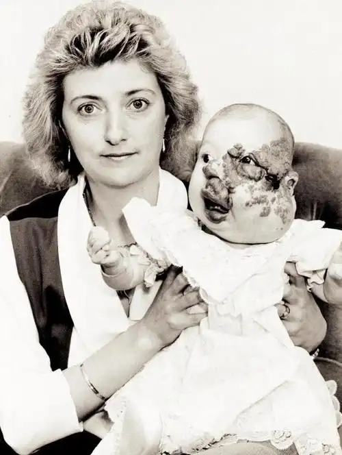 独眼喙鼻婴儿畸形(英国女子先天面部畸形)(1)