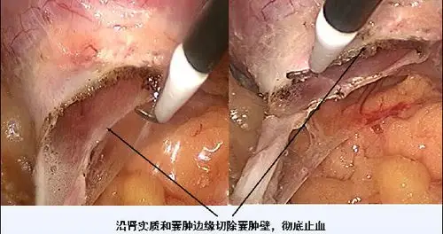 后腹腔镜右肾囊肿去顶减压术--后腹腔镜微创手术