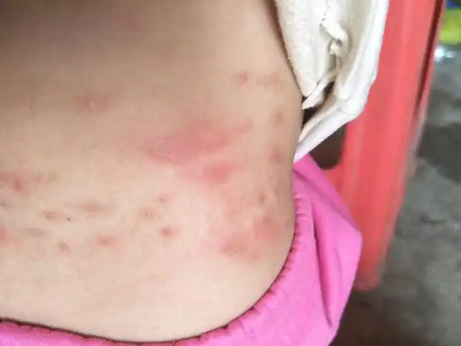 两岁的宝宝,一吃热气的就起痒的,先是很大块的红包