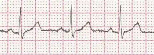 触电会死人,为啥用除颤仪电击胸部能救人?