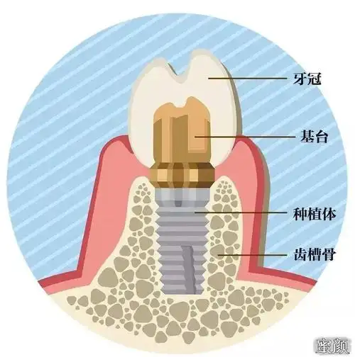【美然】想做种植牙,但是牙槽骨太薄,怎么办?