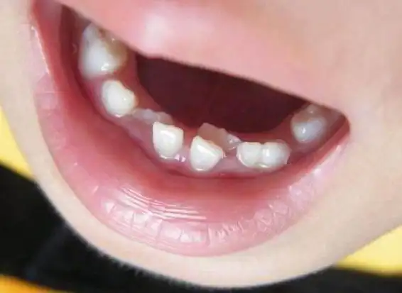 孩子长了双排牙怎么办别急简单两步马上搞定