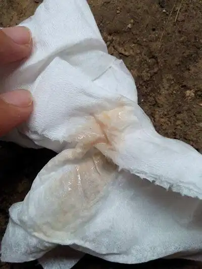 血性白带图片36