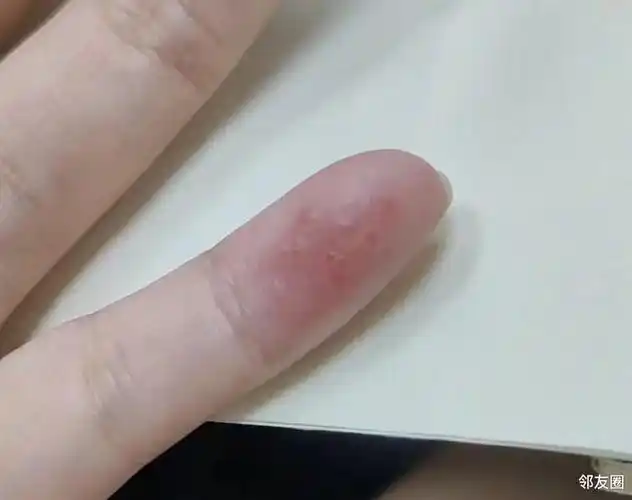 小手指头长了很多小水泡要去医院吗