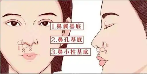 鼻翼基底是鼻唇沟上部和鼻翼交界的三角区域;鼻小柱基底位于两个鼻孔