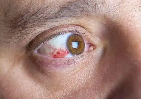 肝不好眼先知一旦眼睛有2种迹象很有可能是肝癌