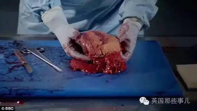 他们解剖胖子遗体拍成纪录片,看完不敢不减肥了!