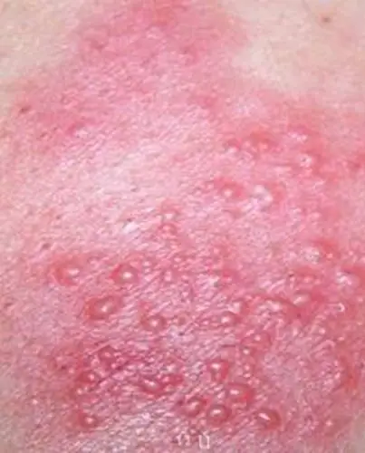 女性股藓症状表现的图片_有来医生