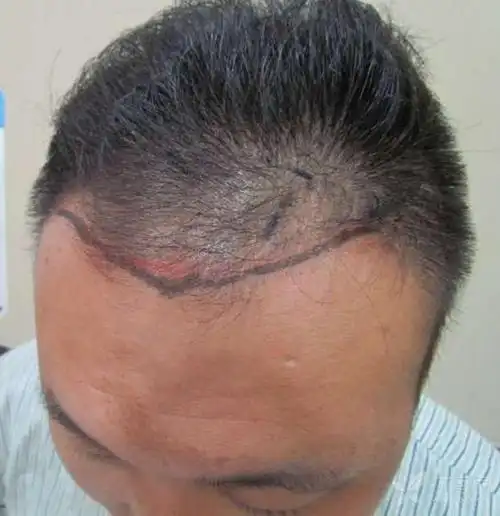 患者二级脱发 额角上移 后枕疤痕