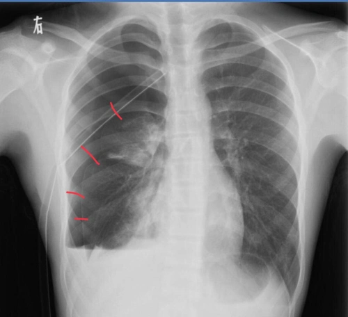 胸部ct 薄层ct可以发现肺大泡,另外一些隐匿部位的气胸,胸片不能发现