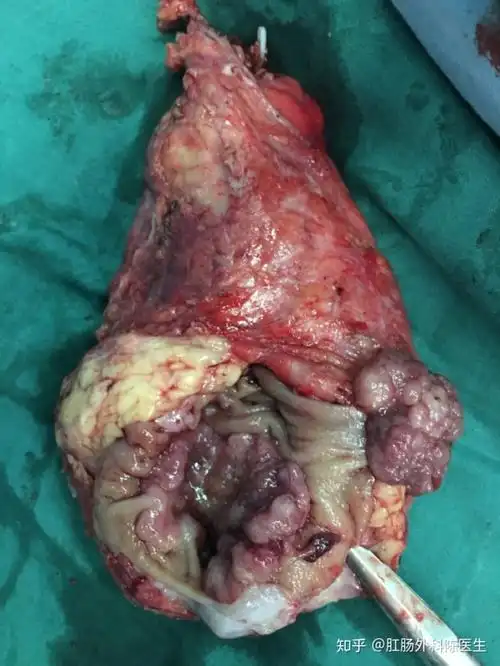 大便带血都是肠癌吗一站让你学会居家如何初步判断便血性质