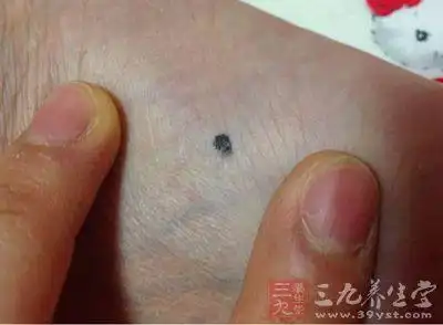 女人这处长个痣走路都捡到钱