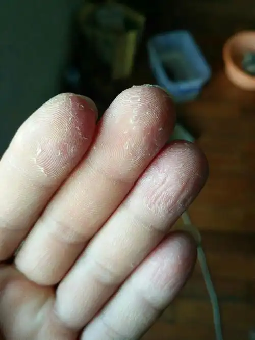 这几天手指老是掉皮,怎么回事呀,有没有解决办法