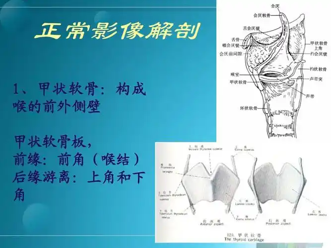 喉部疾病影像诊断  ct  mri 正常影像解剖 1,甲状软骨:构成 喉的前