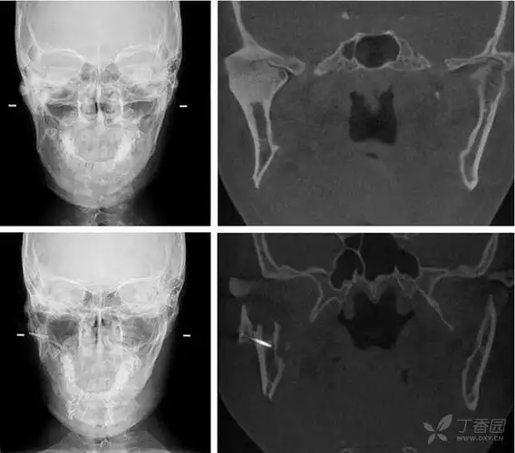 jcs:成人颞下颌关节强直治疗指南