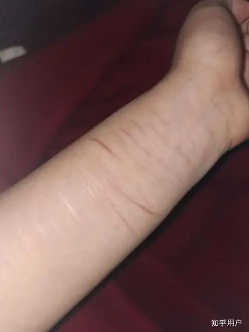 对于一个割腕过的人,未来如何向别人解释这道疤的由来? - 知乎