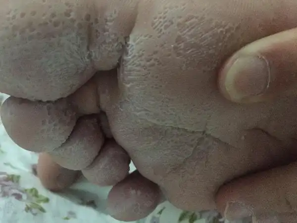 上小学时脚爱出汗脚底发白有许多小坑,但是早上起来脚底又发红一碰就