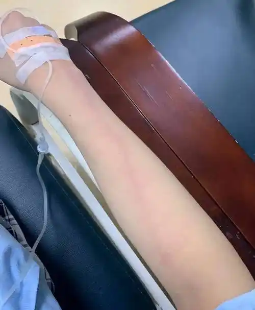 【名院名医】防"炎"于未然 消"炎"于当下:浅谈静脉炎预防与处理_护理