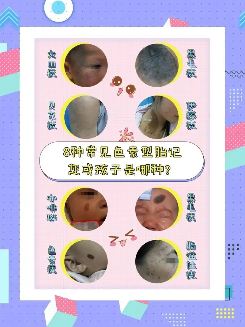 最全干货常几6种色素型胎记科普